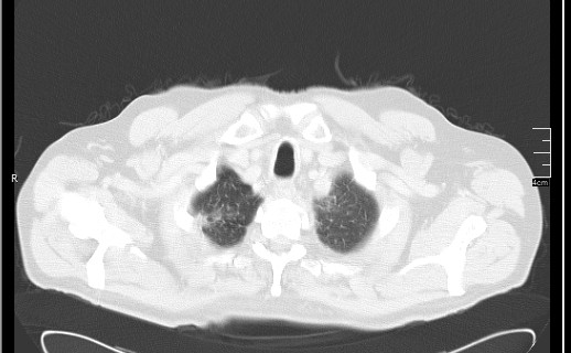 Brain metastases from squamocellular lung cancer (Radiopaedia 56515-63219 Axial lung window 12).jpg
