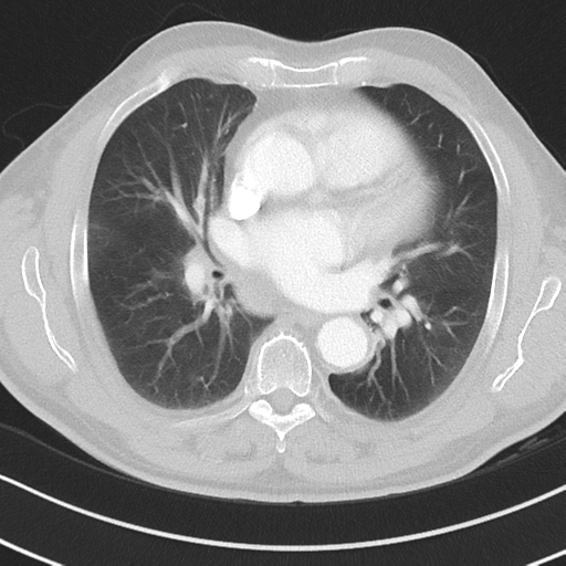 Brain metastasis (large cystic mass) (Radiopaedia 47497-52104 Axial lung window 24).png