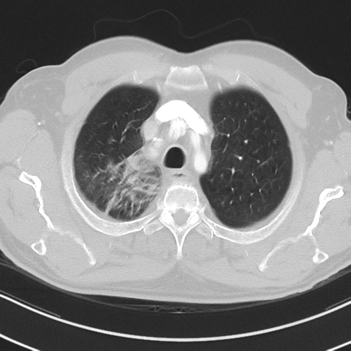 File:Brain metastasis (large cystic mass) (Radiopaedia 47497-52104 Axial lung window 8).png