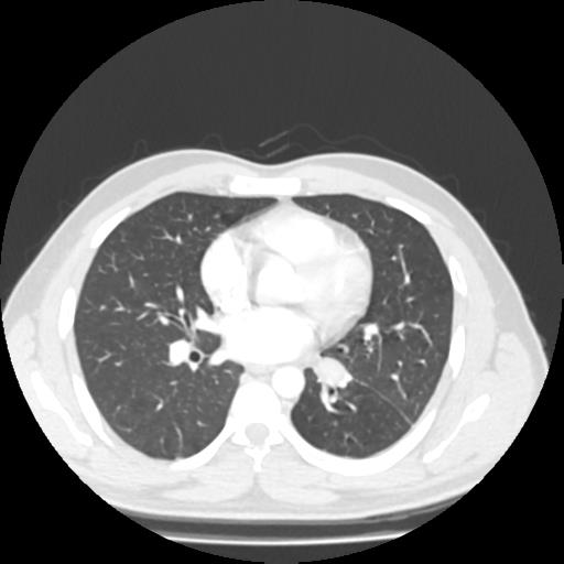 Bronchial carcinoid (Radiopaedia 80013-93291 Axial lung window 64).jpg