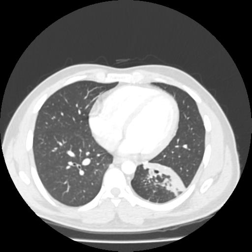 Bronchial carcinoid (Radiopaedia 80013-93291 Axial lung window 81).jpg