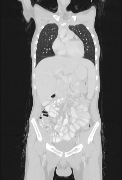 Bronchial carcinoid tumor (Radiopaedia 57187-64090 Coronal lung window 30).jpg