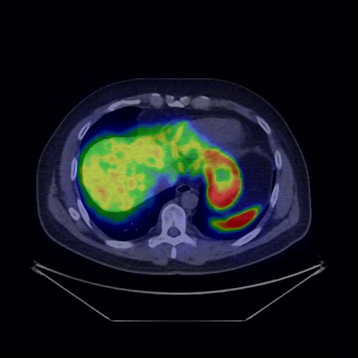 Bronchial carcinoid tumor (Radiopaedia 67377-76765 68Ga-DOTATATE PET-CT 37).jpg