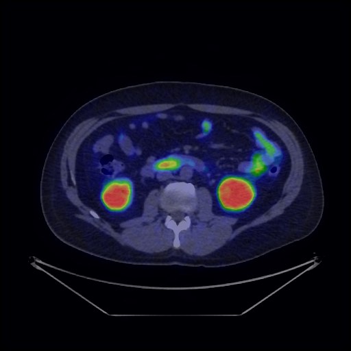 Bronchial carcinoid tumor (Radiopaedia 67377-76765 68Ga-DOTATATE PET-CT 52).jpg