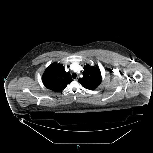 File:Bronchial carcinoid tumor (Radiopaedia 78272-90870 B 31).jpg