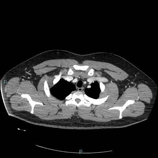 Bronchial carcinoid tumor (Radiopaedia 78272-90875 A 20).jpg