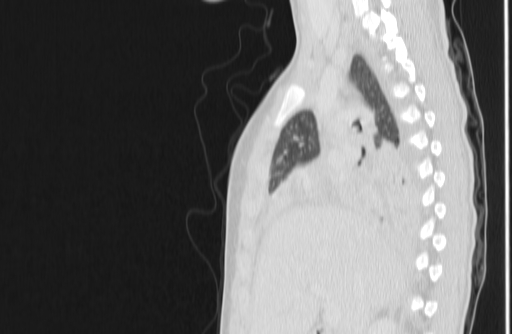 Bronchial mucoepidermoid carcinoma (Radiopaedia 57023-63895 Sagittal lung window 53).jpg
