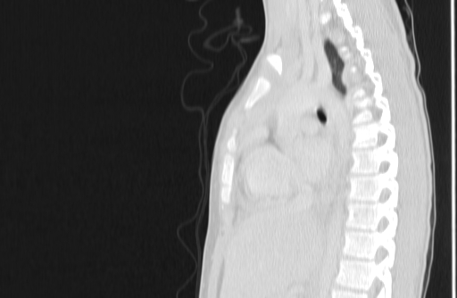 Bronchial mucoepidermoid carcinoma (Radiopaedia 57023-63895 Sagittal lung window 93).jpg