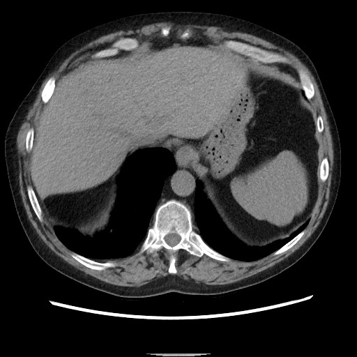 File:Bronchial stenosis - lung transplant (Radiopaedia 73133-83848 Axial non-contrast 52).jpg