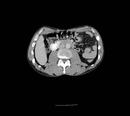 Bronchiectasis in Crohn disease (Radiopaedia 60311-67977 B 81).jpg