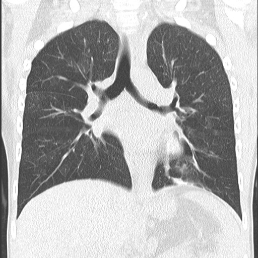 File:Bronchiolotis obliterans (Radiopaedia 73769-84575 Coronal lung window 21).jpg