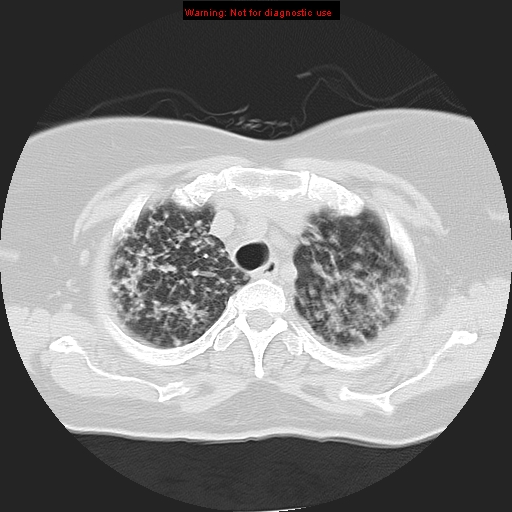Bronchoalveolar carcinoma (Radiopaedia 13224-13233 Axial lung window 11).jpg