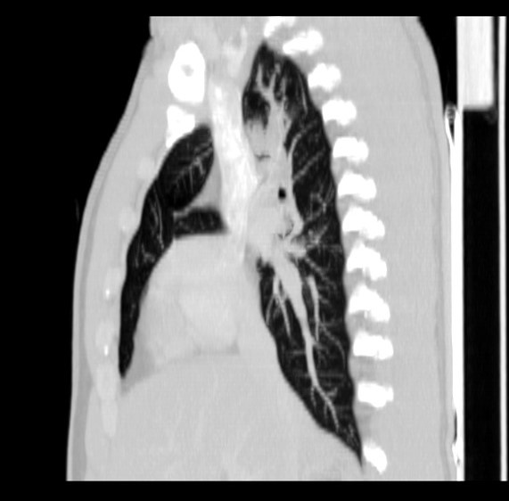 File:Bronchocele (Radiopaedia 12104-12460 Sagittal lung window 1).jpg