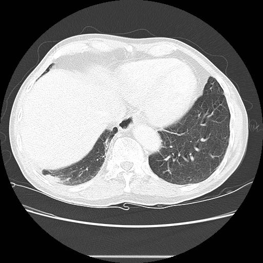 Bronchocele (Radiopaedia 17097-16795 Axial lung window 95).jpg