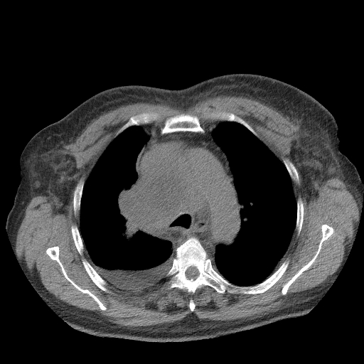 Bronchogenic carcinoma with metastatic lymphadenopathy (Radiopaedia 37671-39569 Axial non-contrast 18).jpg