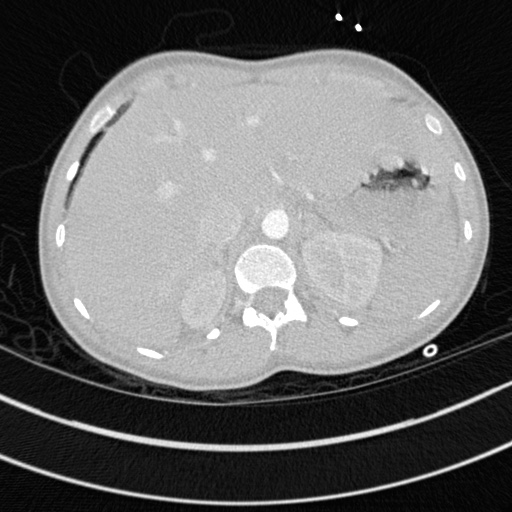 File:Bronchogenic cyst (Radiopaedia 77801-90071 Axial lung window 83).jpg