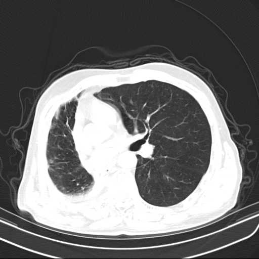 Bronchopleural fistula - postoperative complication (Radiopaedia 21020-20947 Axial lung window 27).jpg