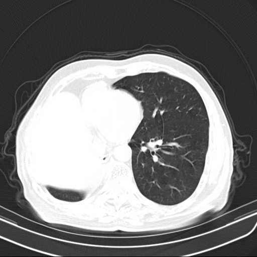 Bronchopleural fistula - postoperative complication (Radiopaedia 21020-20947 Axial lung window 37).jpg
