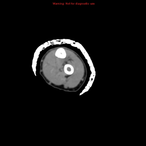 Brown tumor (Radiopaedia 12460-12694 Axial non-contrast 102).jpg
