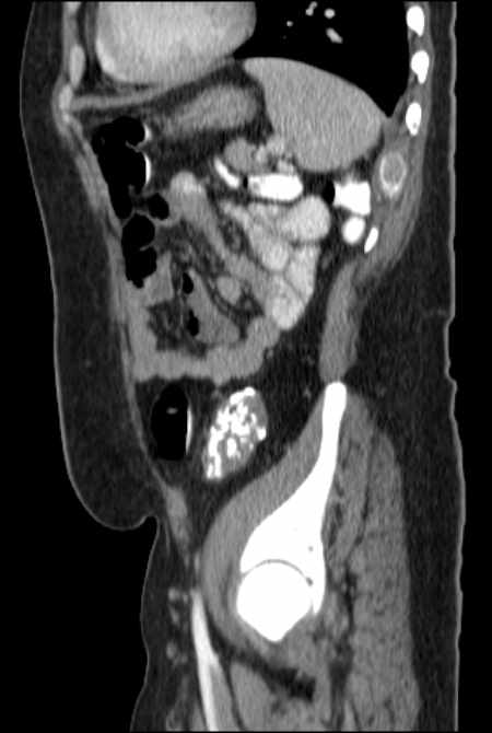 Brown tumors compressing the spinal cord (Radiopaedia 68442-77988 F 42).jpg
