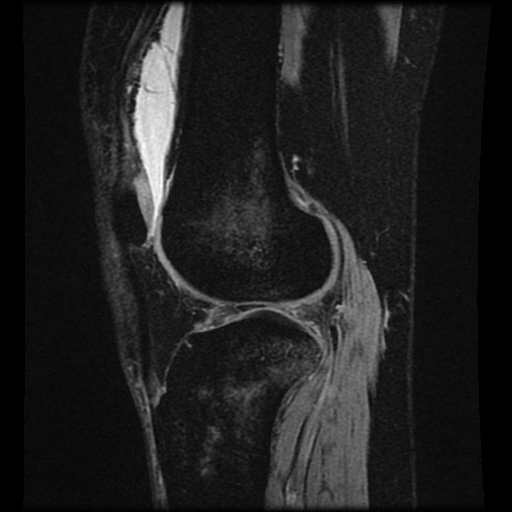 Bucket handle meniscus tear (Radiopaedia 56916-63751 H 27).jpg