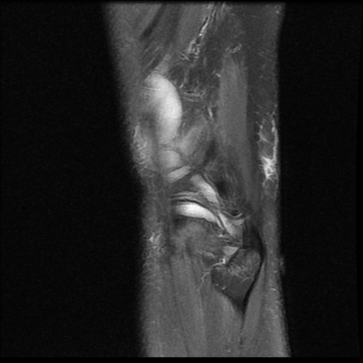 File:Bucket handle meniscus tear (Radiopaedia 56916-63751 Sagittal PD fat sat 2).jpg