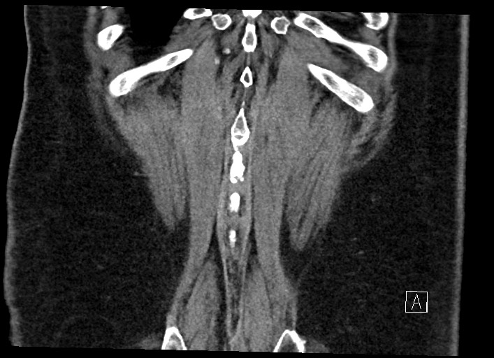 Buried bumper syndrome - gastrostomy tube (Radiopaedia 63843-72577 Coronal Inject 129).jpg