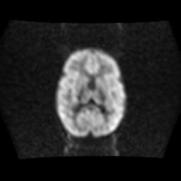 File:Burkitt lymphoma of the orbit- pre and post chemotherapy (Radiopaedia 31214-31930 Axial DWI 10).jpg