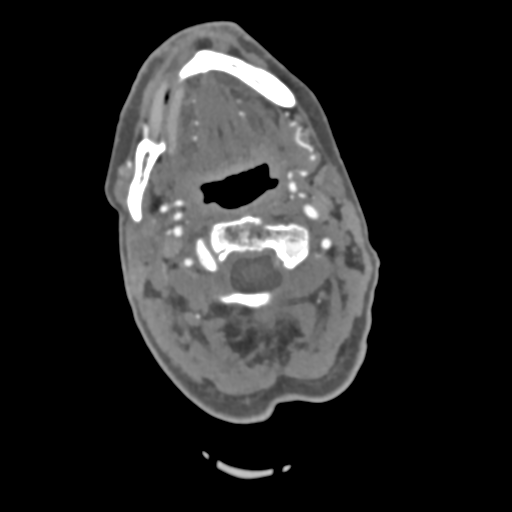 C2 fracture with vertebral artery dissection (Radiopaedia 37378-39200 A 166).png