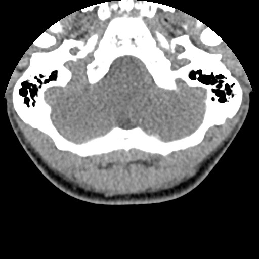 File:C5 facet fracture (Radiopaedia 58374-65499 Axial non-contrast 2).jpg