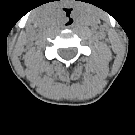 File:C5 facet fracture (Radiopaedia 58374-65499 Axial non-contrast 32).jpg