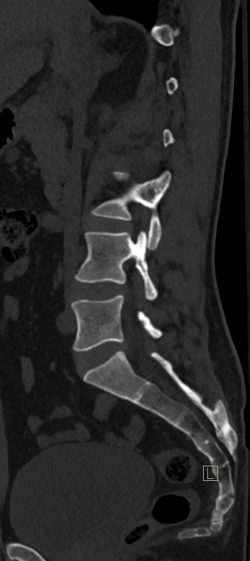 Calcaneal fractures with associated L2 burst fracture (Radiopaedia 71671-82493 Sagittal bone window 50).jpg
