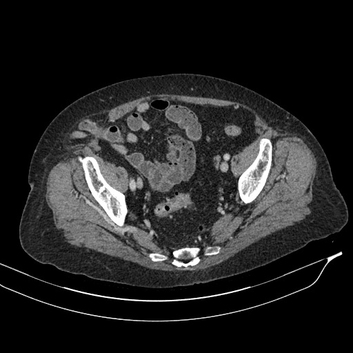 Calcified adrenal glands and Spigelian hernia (Radiopaedia 49741-54988 A 198).jpg