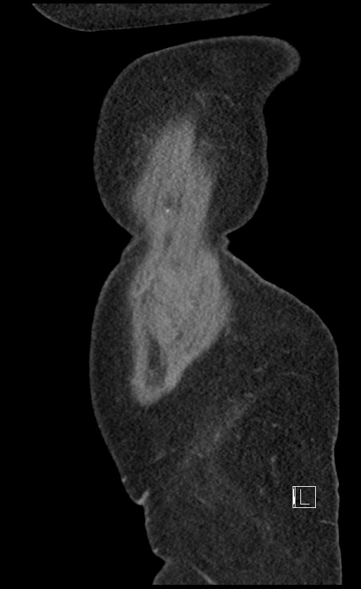 Calcified adrenal glands and Spigelian hernia (Radiopaedia 49741-54988 C 154).jpg