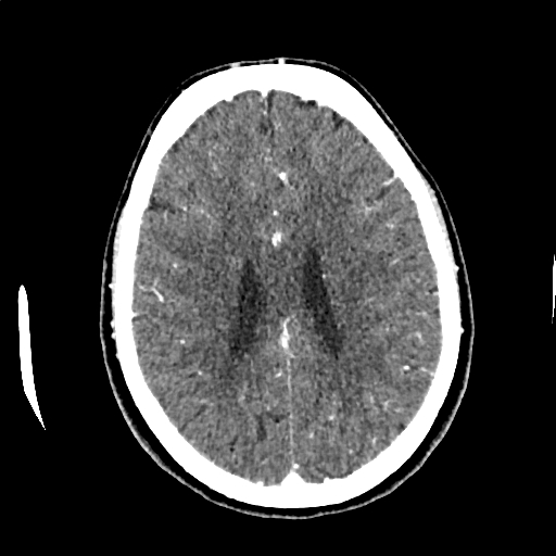Calcified cerebral hydatid cyst (Radiopaedia 65603-74717 Axial with contrast 51).jpg