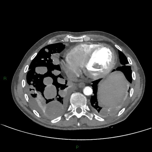 File:Cannonball metastases (Radiopaedia 82110-96150 Axial C+ CTPA 236).jpg