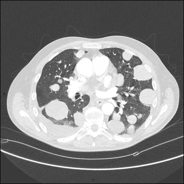 Cannonball metastases (Radiopaedia 82110-96150 Axial lung window 102).jpg