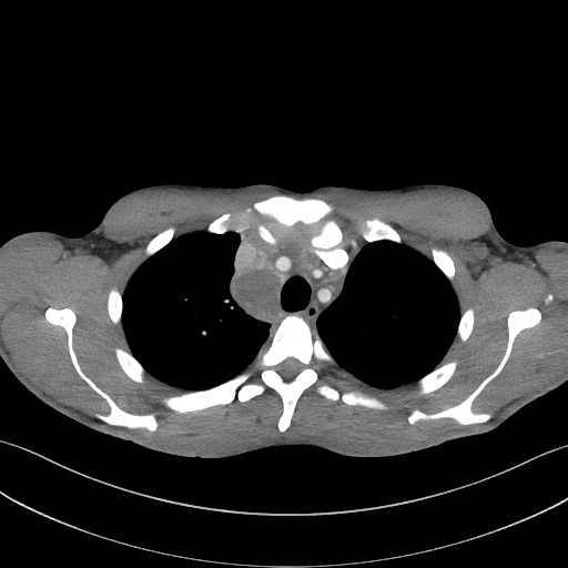 Cannonball metastases - testicular choriocarcinoma (Radiopaedia 84510-99891 B 33).jpg