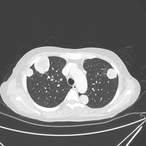 File:Canonball lung metastasis (Radiopaedia 77634-89837 Axial lung window 52).jpg
