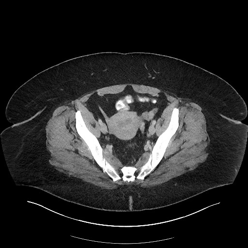 File:Carcinoid tumor - terminal ileum (Radiopaedia 60931-68739 A 110).jpg