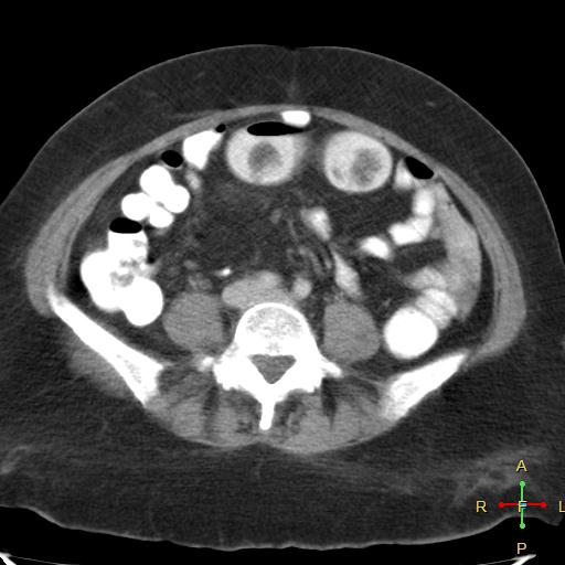 File:Carcinoma of sigmoid colon (Radiopaedia 23071-23100 B 14).jpg