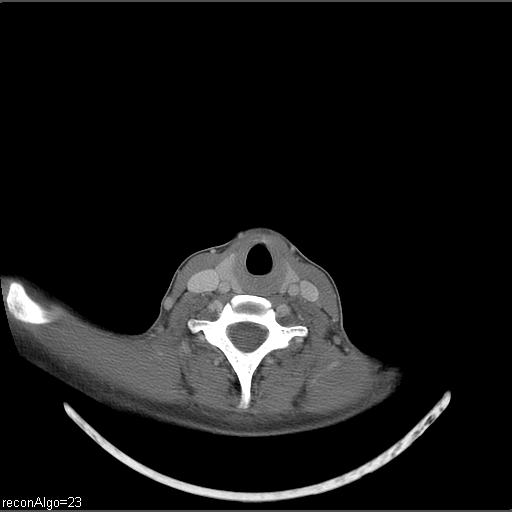 Carcinoma of the maxillary antrum (Radiopaedia 53805-59888 Axial C+ delayed 12).jpg