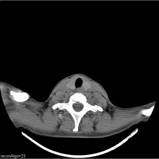 Carcinoma of the maxillary antrum (Radiopaedia 53805-59888 Axial non-contrast 14).jpg