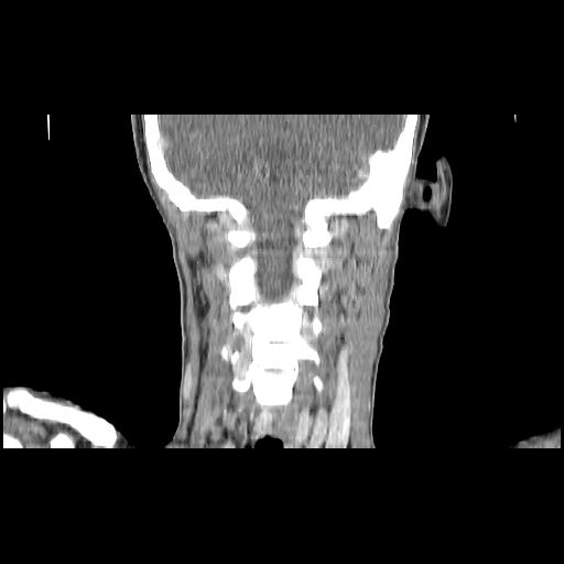 Carcinoma of the maxillary antrum (Radiopaedia 53805-59888 Coronal C+ delayed 117).jpg