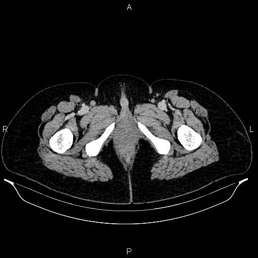 Carcinoma of uterine cervix (Radiopaedia 85861-101700 A 79).jpg