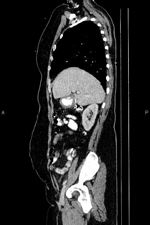 Carcinoma of uterine cervix (Radiopaedia 85861-101700 D 20).jpg
