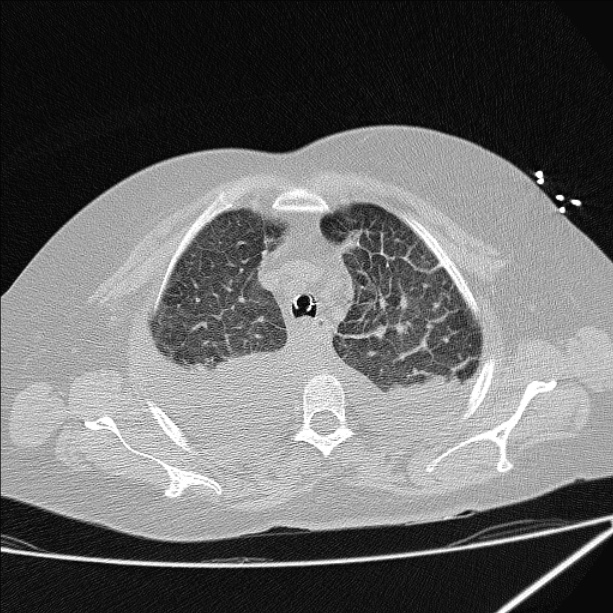 Cardiogenic pulmonary edema (Radiopaedia 29213-29609 Axial lung window 17).jpg
