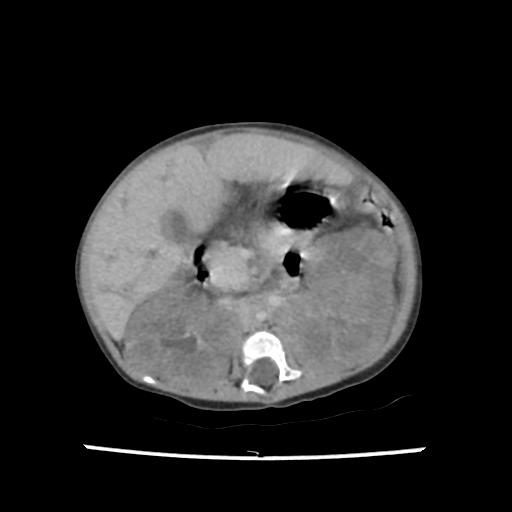 File:Caroli disease with autosomal recessive polycystic kidney disease (ARPKD) (Radiopaedia 89651-106703 B 100).jpg