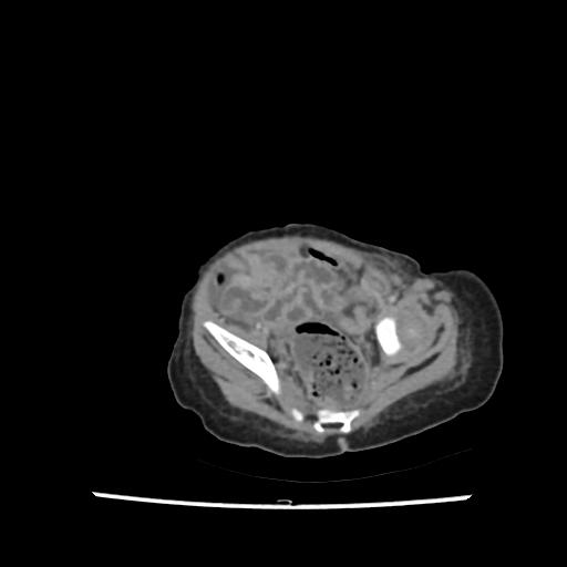 File:Caroli disease with autosomal recessive polycystic kidney disease (ARPKD) (Radiopaedia 89651-106703 B 200).jpg