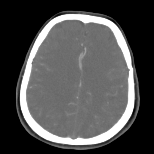 Carotico ophthalmic aneurysm (Radiopaedia 42916-46148 A 19).png
